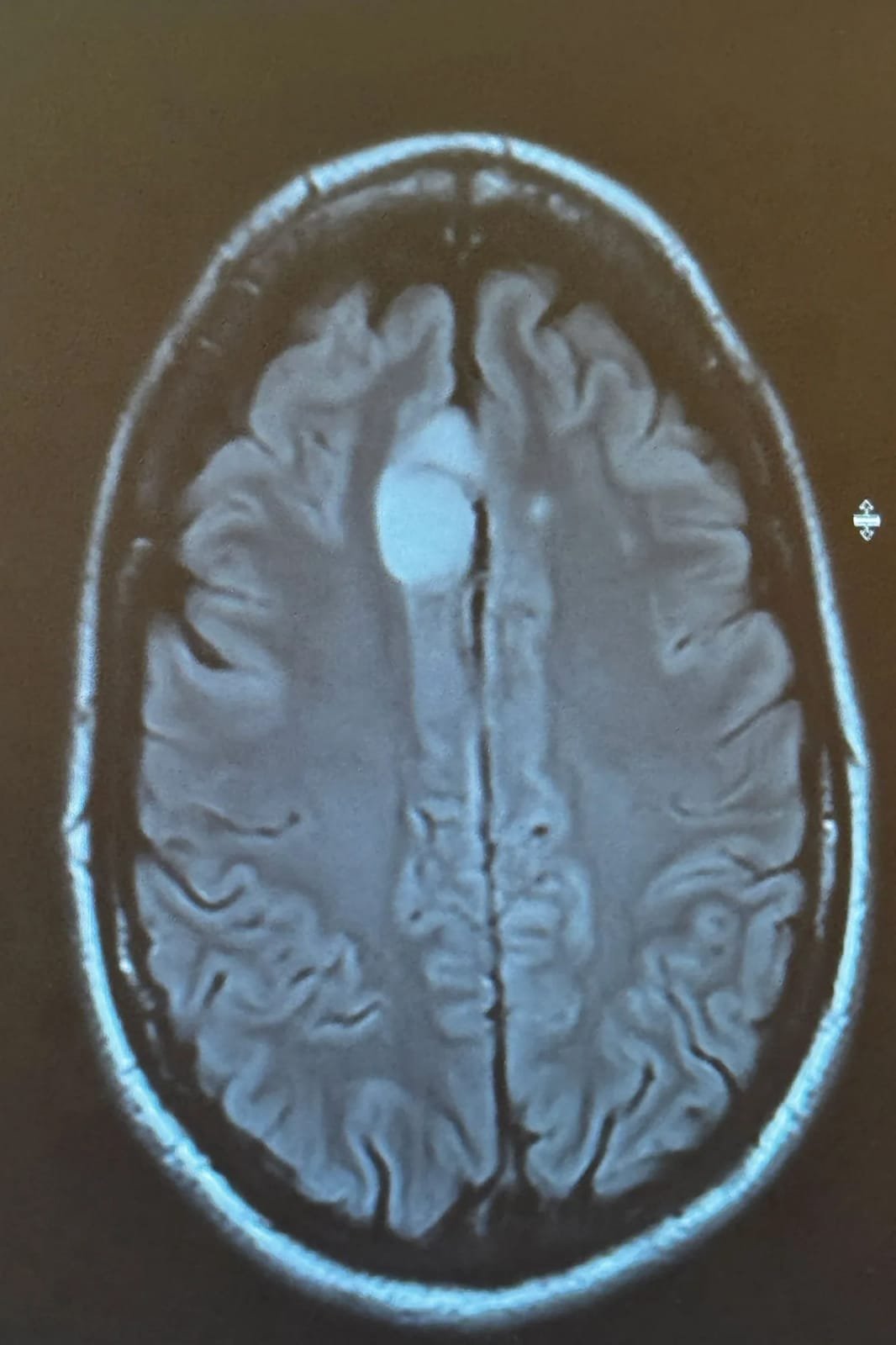 Busy Philipps Reveals Brain Tumor Surgeries 2b27aea8 38bd 48e1 be5c 71b7ae8857c6