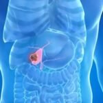 Medical diagram showing gallbladder stone formation and diagnostic ultrasound
