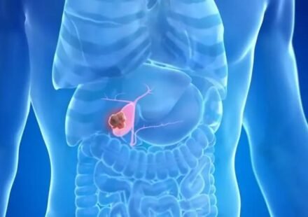 Medical diagram showing gallbladder stone formation and diagnostic ultrasound