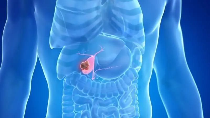  Medical diagram showing gallbladder stone formation and diagnostic ultrasound